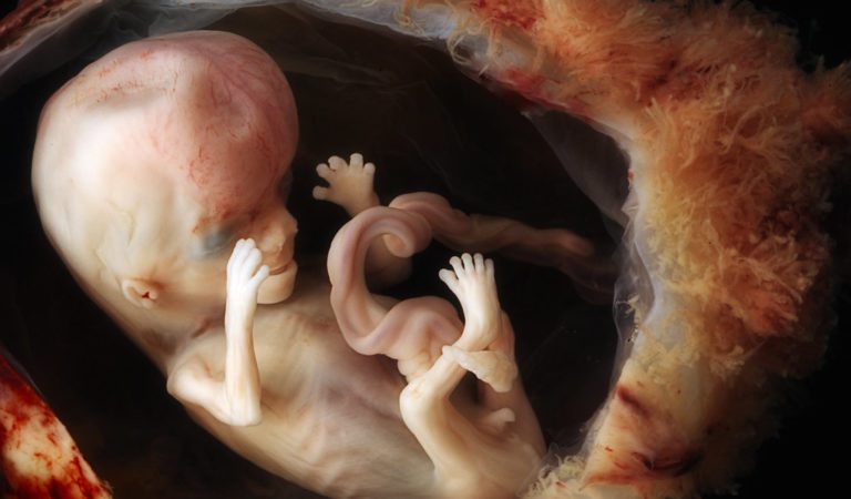 The Reality of Abortion, NPR Plays Audio of Abortion on Air (WARNING: EXTREMELY GRAPHIC)